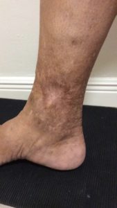 what is lipodermatosclerosis