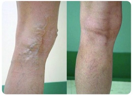 varicose vein treatment before and after #1