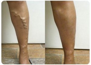 varicose vein treatment before and after