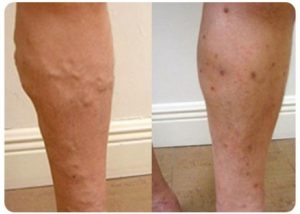 varicose vein treatment before and after