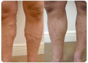 varicose vein treatment before and after