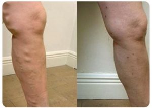 varicose vein treatment before and after
