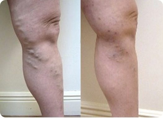 varicose vein treatment before and after