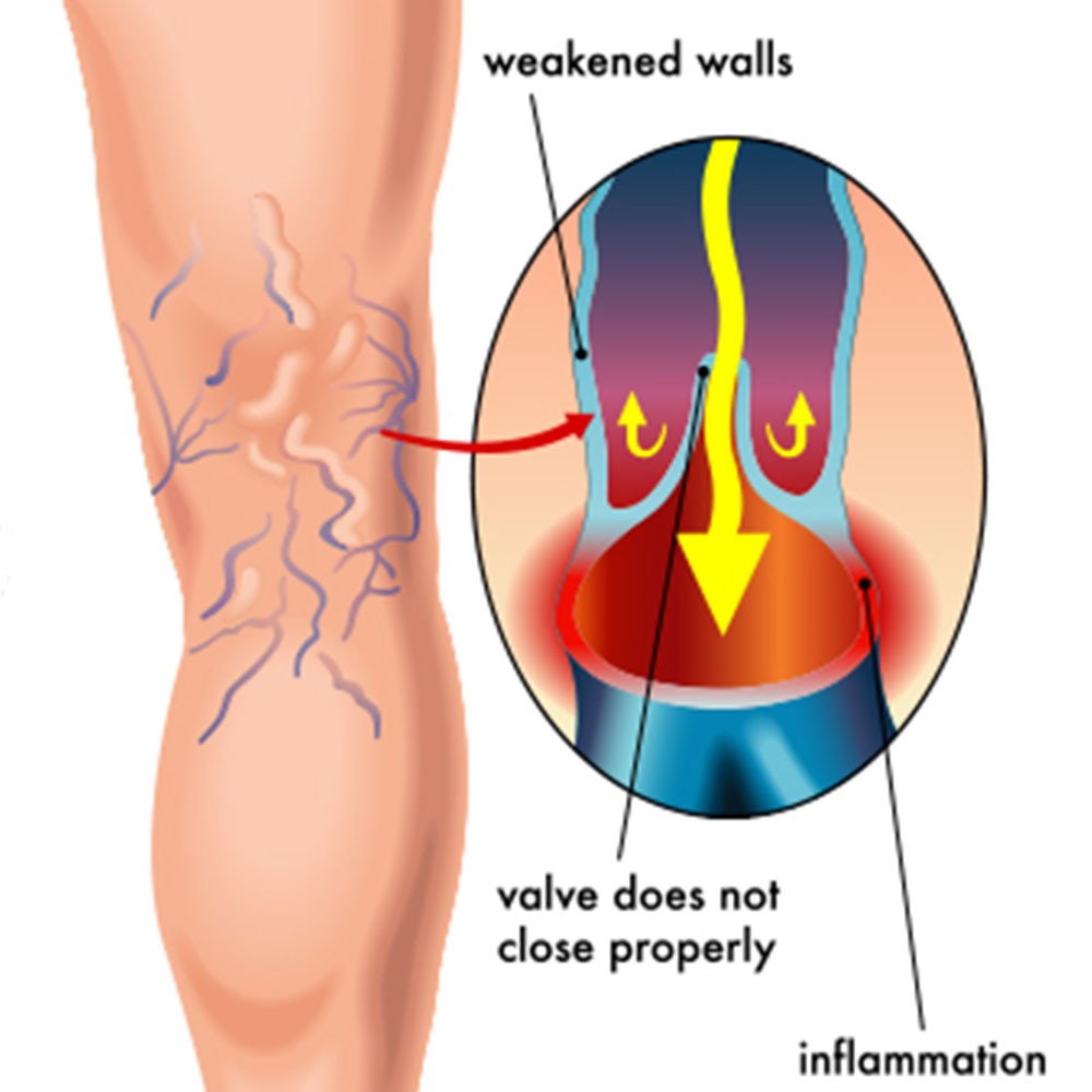 varicose vein cause illustration