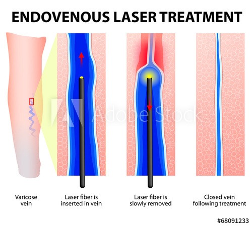 Endovenous Vein Ablation Miami - Laser Treatment