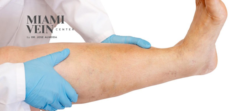 ankle and leg swelling