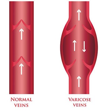 varicose vein vs normal vein illustration at the Miami vein center