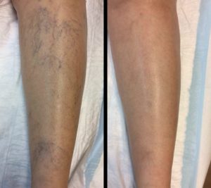 spider vein removal treatment