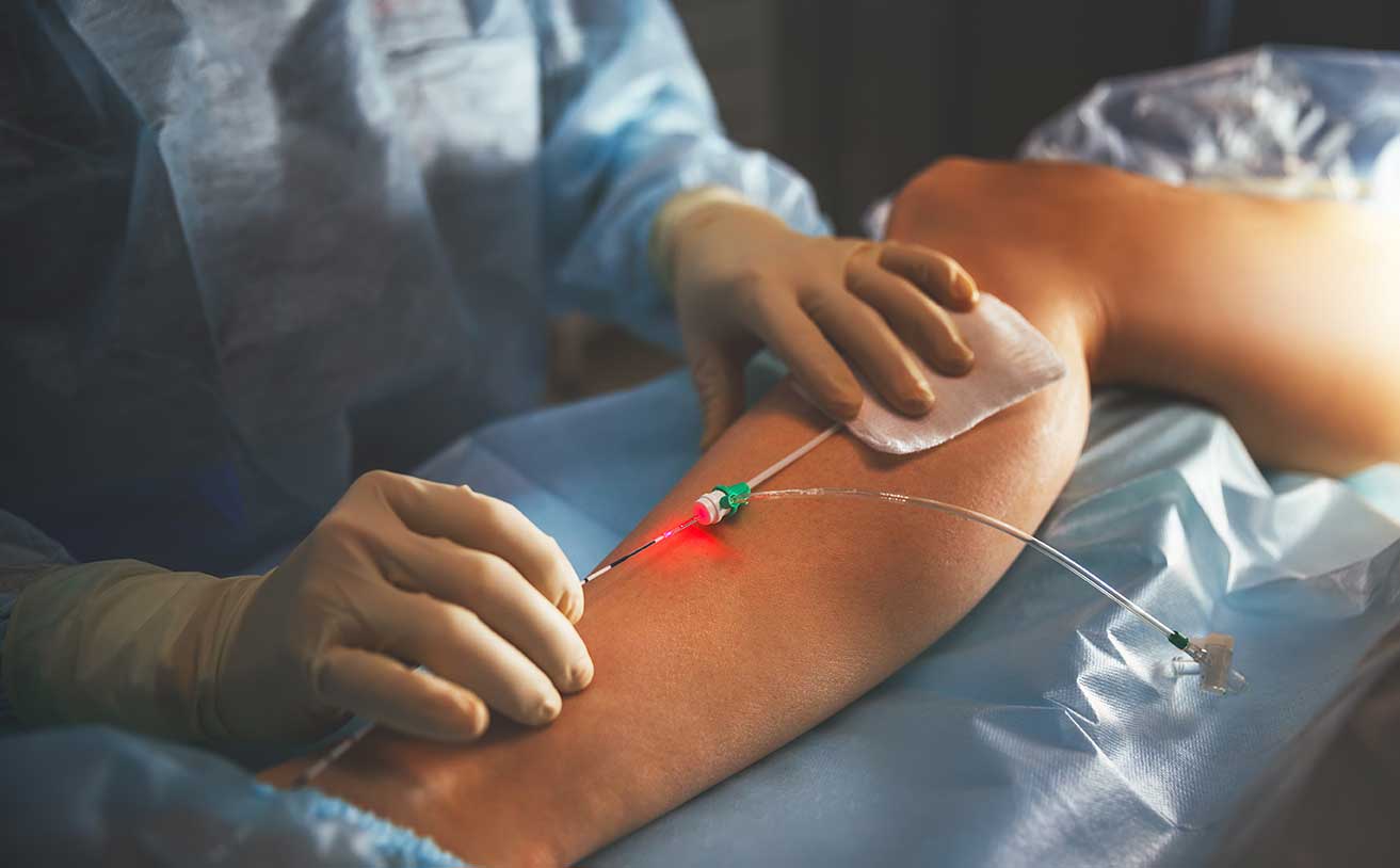 removing-varicose-veins-miami-vein-center varicose vein surgery