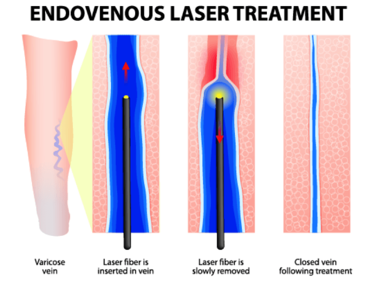varicose veins laser treatment