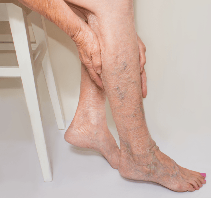 candidate for varicose vein surgery