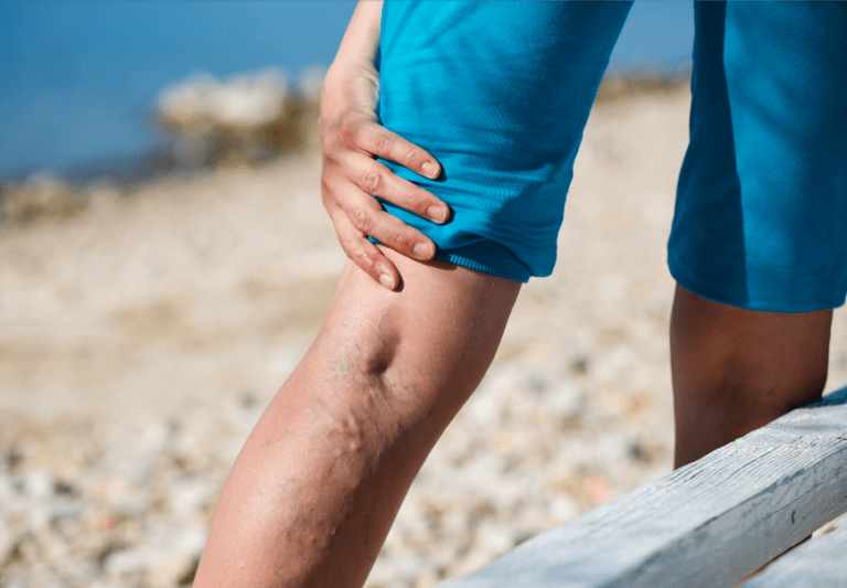 varicose veins pain relief