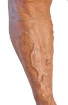 varicose veins dangerous