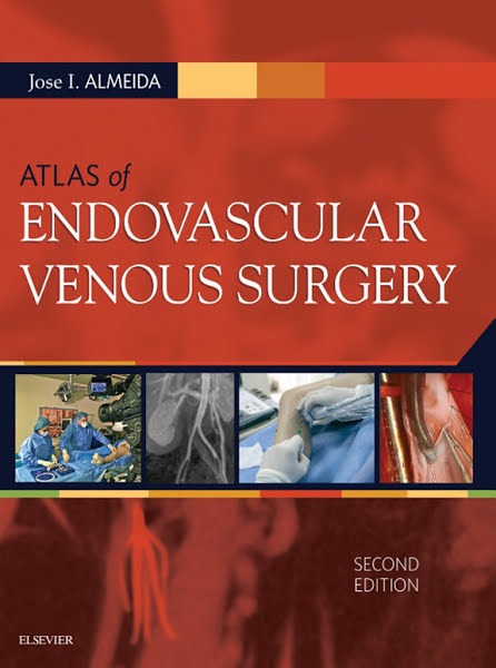 Endovascular Venous Surgery by Dr. Jose Almeida 2nd Edition