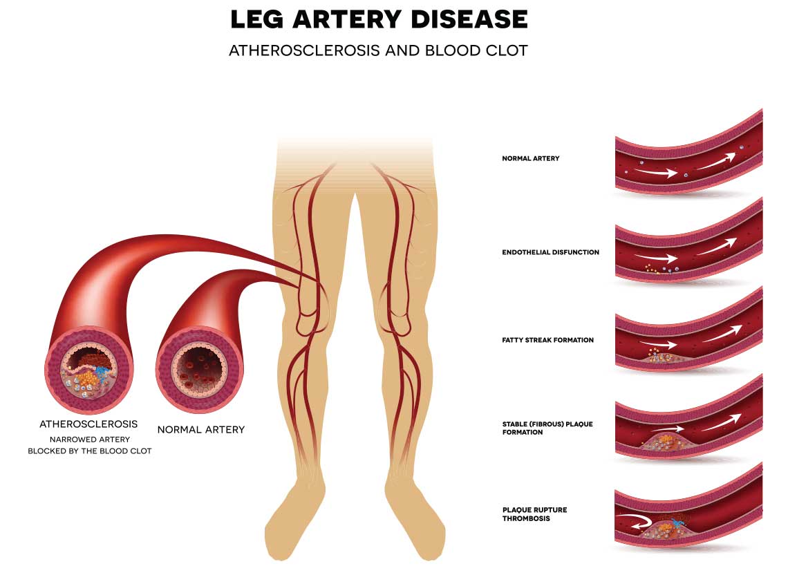 leg artery disease illustration