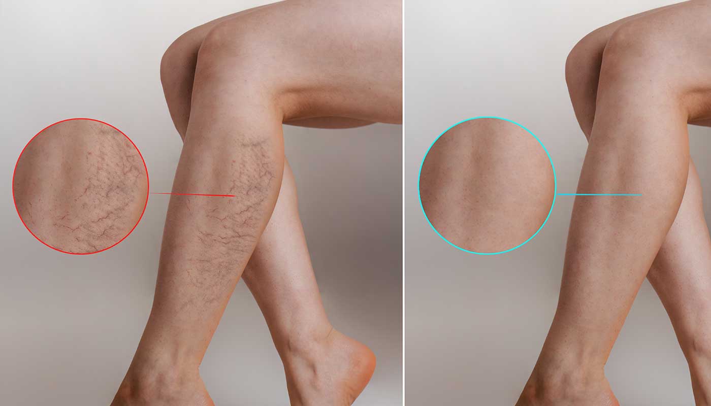 spider veins before and after treatment