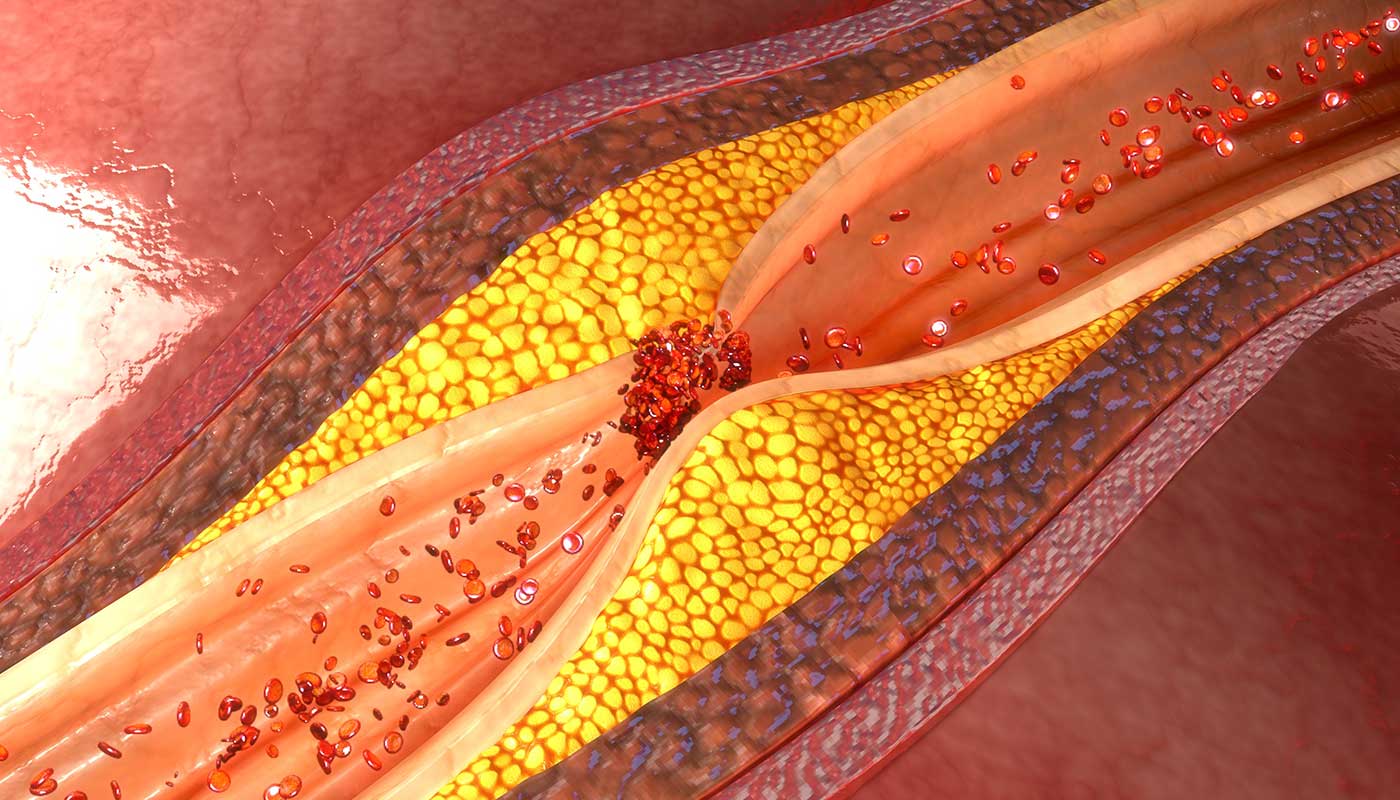 vascular disease blood clot