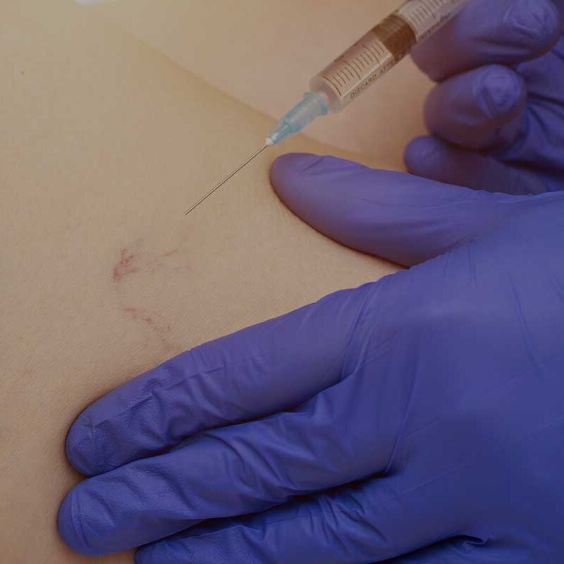 tirzepatide injected into vein What Hurts More? Sclerotherapy or Laser Treatment