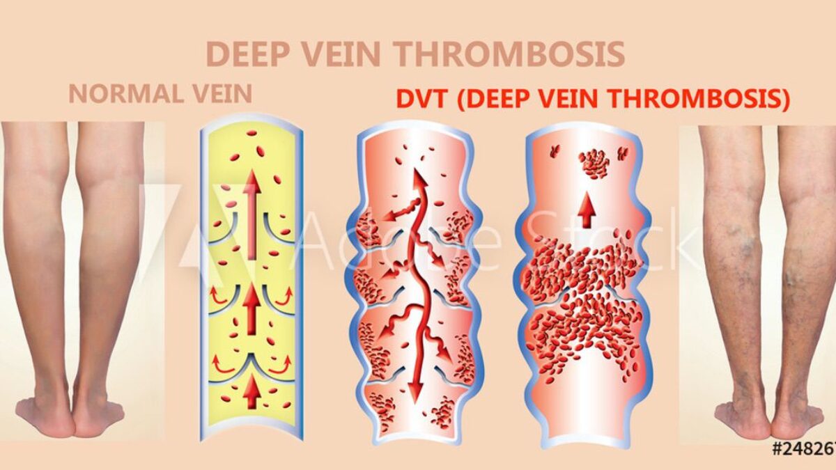 tirzepatide dvt Risk of Deep Vein Thrombosis DVT