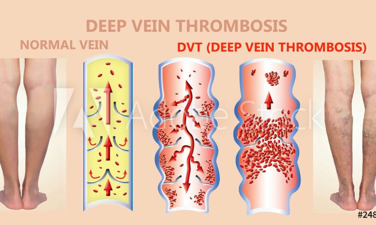 tirzepatide and dvt Am I at Risk for DVT? | Miami Vein Center