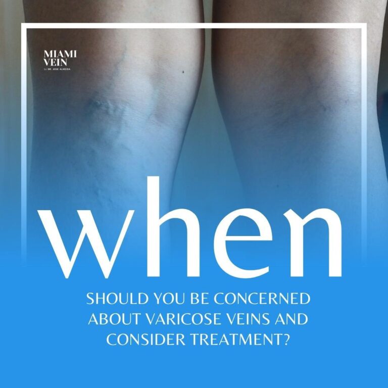 When is it time to Treat Varicose Veins? Miami Vein Center
