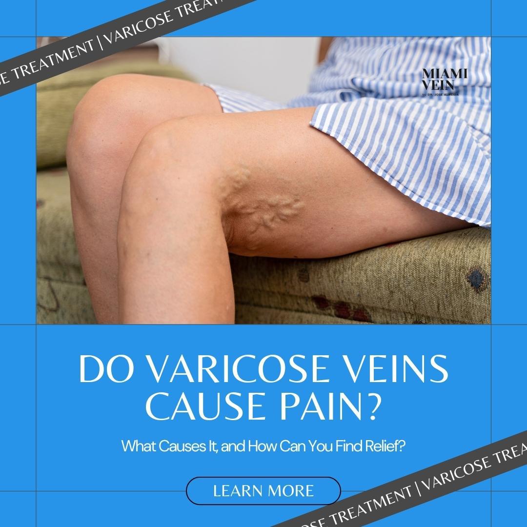 MVC_-_Do_Varicose_Veins_Cause_Pain_-_IG_(2)